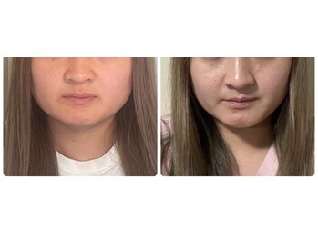 小顔矯正サロン ブルーム/1回の施術でエラ張り解消