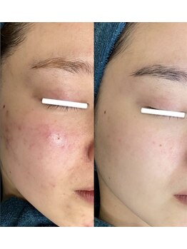 晴(haru)/ハーブピーリング