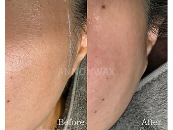 ポアラ(POARA)/毛穴/ワックス脱毛