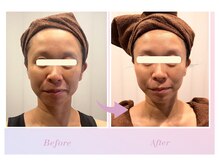 モルティー 宇都宮本店(Molti)/たるみ改善