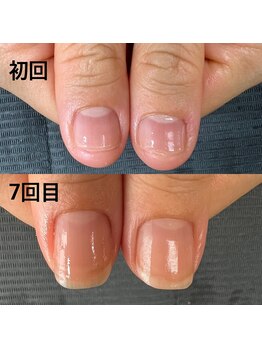 ピュアティネイル(purity nail)/最強ネイルケア