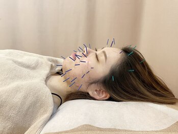 こじま 富雄団地接骨院/たるみ改善☆美容鍼