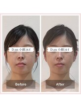 ディードットアン(D.an)/小顔コルギ