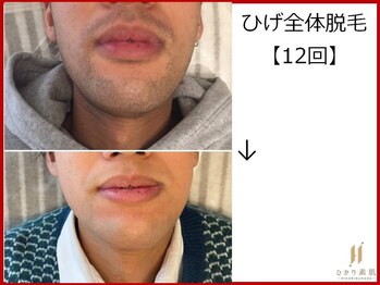 ひかり素肌/ひげ脱毛12回