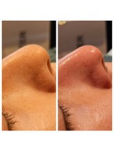 ラデュープラス(Radieux+)/韓国式3D毛穴洗浄