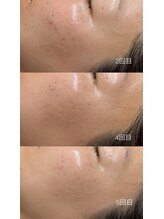 フーフラット(Huu flat)/フェイシャルワックス