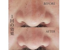 ユニ(uni.)の雰囲気(効果を即実感できる【毛穴エクストラクション】毛穴レス肌へ)