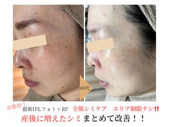 エソア(esoa)/40代 光フォト8回