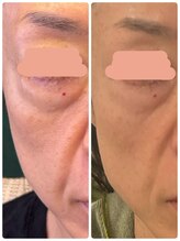 だれでもエステ 北浜店/継続は結果に！クマ＆ほうれい線