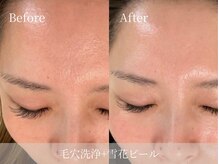 アパラギ(Aparagi)の雰囲気（【毛穴管理】毛穴洗浄+雪花ピールで根本改善）