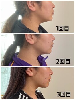 ラディユー(Radieux)/レモンボトルお客様施術例