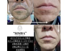 メンズ シンバ(SIMBA)の雰囲気（SIMBAが提供するクリアスキン脱毛の効果です。）