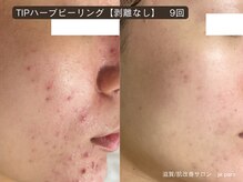 ジュパール(je pars)/TIPハーブピーリング　剥離なし