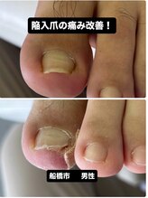 巻き爪じゅん 千葉駅前店/陥入爪が痛い巻き爪との違い解説