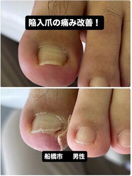 巻き爪じゅん 千葉駅前店/陥入爪が痛い巻き爪との違い解説
