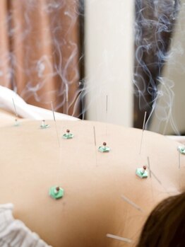 門前仲町イエティ鍼灸整骨院(旧:イエティ鍼灸整骨院)の写真/キレイと健康を同時に叶える☆ダイエットプログラム+ポイントはり施術体験◎