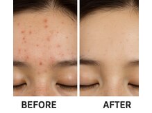 アメノチハレ(ame nochi hare)/毛穴の中からスッキリ綺麗に！