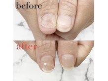 爪の悩み解決♪深爪矯正/パラジェル/フィルイン/長さだし