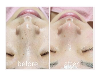 キレイラボ(Ki-Re-i LABO)/ハイドラ+ハーブピーリング