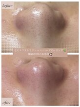 ユニ(uni.)/毛穴ex × ハーブピーリング症例