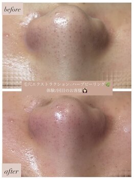 ユニ(uni.)/毛穴ex × ハーブピーリング症例