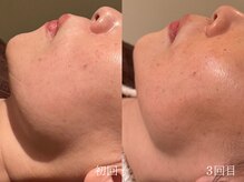 ウォーム(warm)/シワケア/小顔/マッサージ/小顔