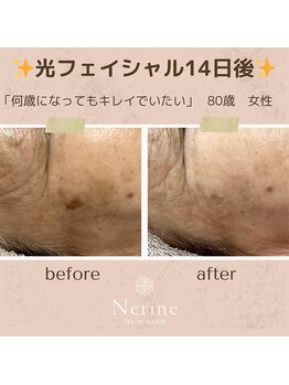 ネリネ(Nerine)/長年蓄積されたシミもキレイに！