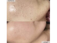 ストーミー(STORMI)/ローズドメーラ before → after