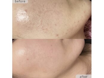 ストーミー(STORMI)/ローズドメーラ before → after