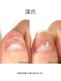20代/深爪/3ヶ月後アフター