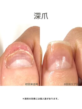 20代/深爪/3ヶ月後アフター