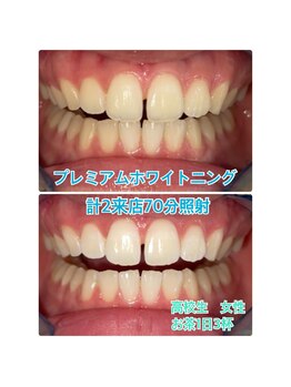 プラチナムビューティー 川口駅前店(PLATINUM BEAUTY)/２来店70分ビフォーアフター