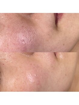 シロ(siro)/韓国水光肌・美白フェイスWax