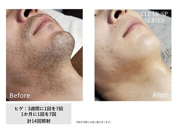 ザ エッセンシャル 碧南(THE Essential)/メンズ ヒゲ脱毛