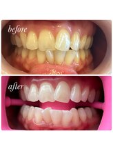 ティースホワイトニング 沖縄うるま市(Teeth Whitning)/ビフォーアフター 30代 女性