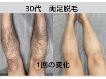 ビモア(Bmore)/★ビフォーアフター★