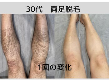 ビモア(Bmore)/★ビフォーアフター★