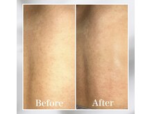 リリ(LiLi)/アンストレス・ビフォーアフター