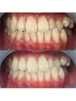 モゼ(moze)/美白ホワイトニング