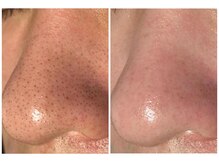 モーヴ(MAUVE)/韓国式３D毛穴洗浄