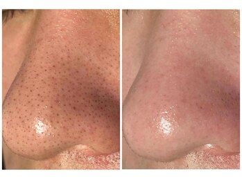 モーヴ(MAUVE)/韓国式3D毛穴洗浄