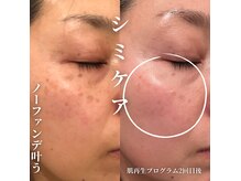 モモ(MOMO)の雰囲気（シミ改善　ビフォーアフター）