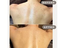 ガーオガーオ 新宿 四ツ谷(GaaoGaao)/ハーブピーリング/背中/4回目