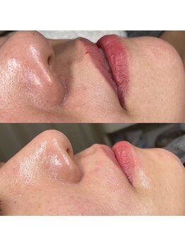 シロ(siro)/韓国水光肌・美白フェイスWax