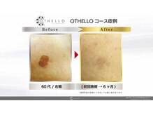 わたしの 大阪枚方本店/諦めていた頑固なシミ改善