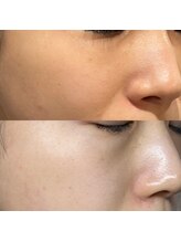 ヨハク 市川店(yohaku)/ワイコ水光ピール