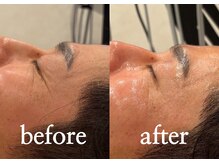 ボヌール(bonheur)/Gloss肌トリートメント