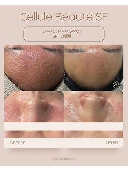 リコンディショニング ビューティー アール(Re.conditioning beauty R)/人気のピーリング♪