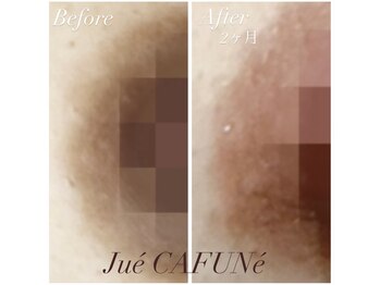 ジュエカフネ 広尾(JueCAFUNe)/ルメラメラニンケア、バスト症例