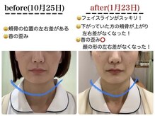 福田整体院/小顔施術3か月